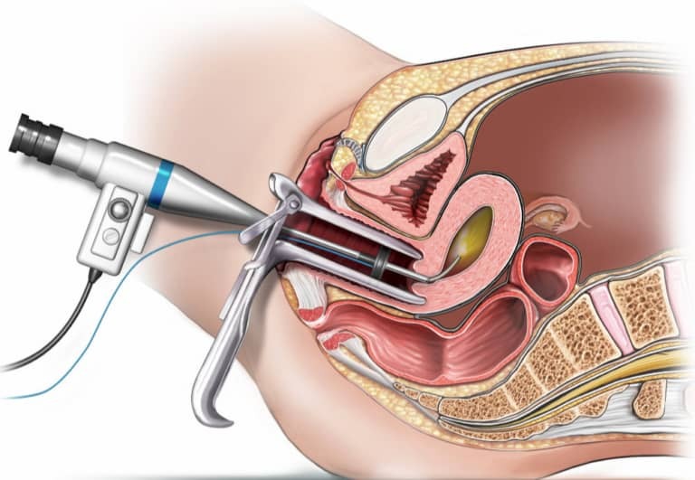 Hysteroscopy